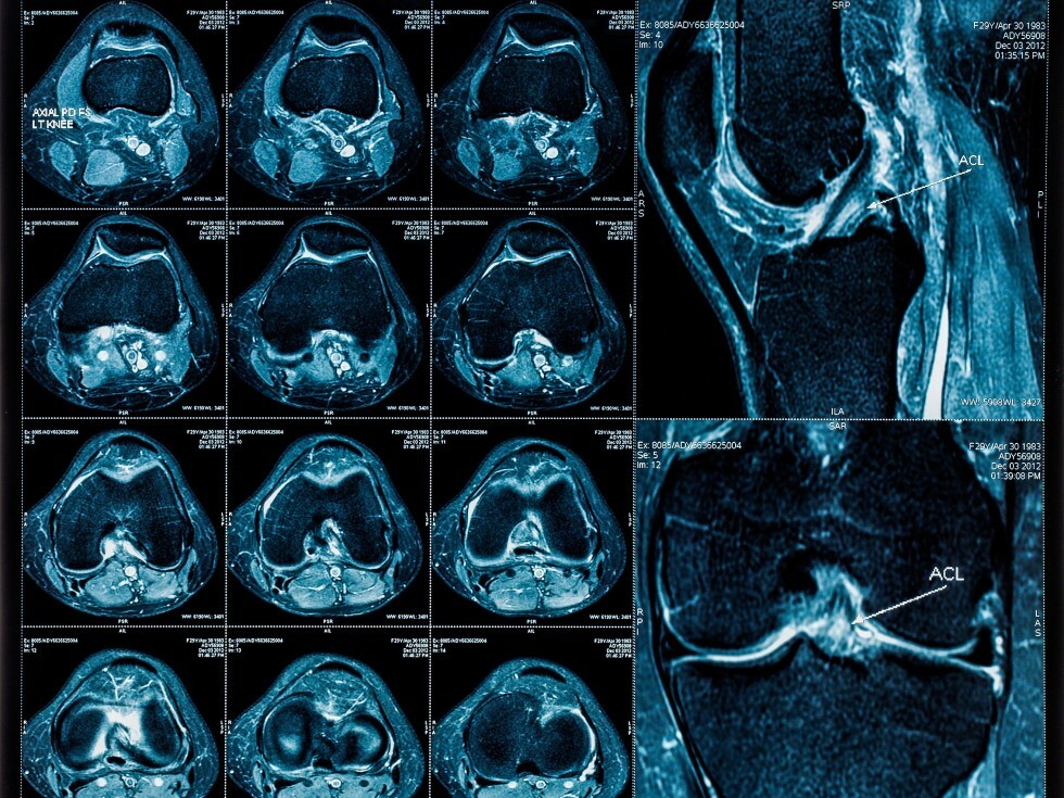 MRI of knee images collage